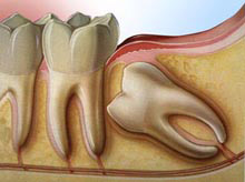 Wisdom Tooth